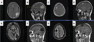 Case report: Two unique cases of co-existing primary brain tumors of glial origin in opposite hemispheres